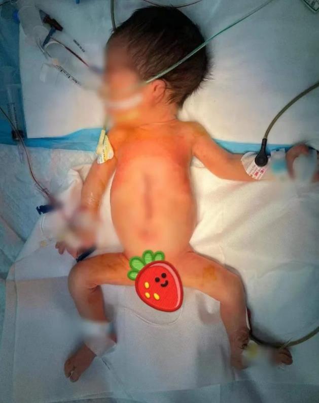 全球罕见寄生胎,深圳一男婴出生时四手四脚